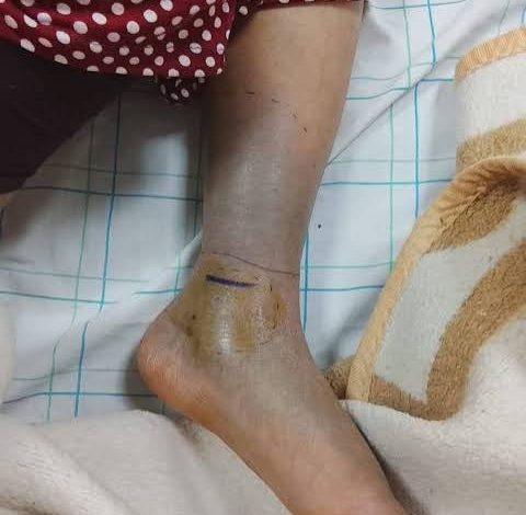 استنفار طبي في طاطا إثر نقل سيدة تعرضت للدغة أفعى قرنية إلى المستشفى العسكري بكلميم
