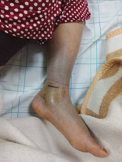 لدغة أفعى قرنية تستنفر الأطقم الطبية بطاطا وتفرض نقل مصابة للمستشفى العسكري بكلميم