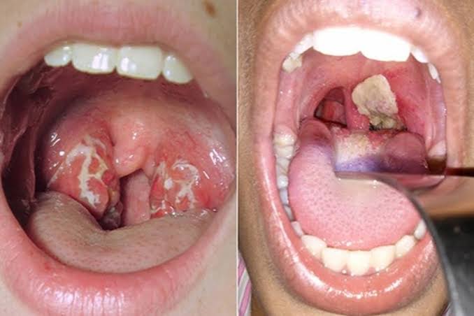 وزارة الصحة المغربية تسجل بؤرتين لداء الخناق بجهة سوس ماسة وتدعو لمراجعة دفاتر التلقيح